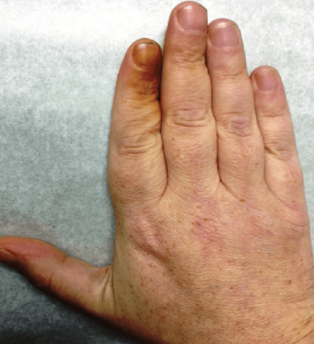A Man With Yellowish Nail Discoloration Consultant360